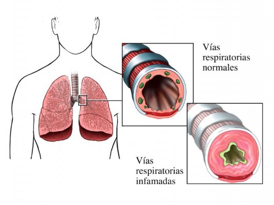 Sugerencias para controlar el asma