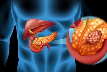 5 cosas que debe saber sobre el cáncer de páncreas