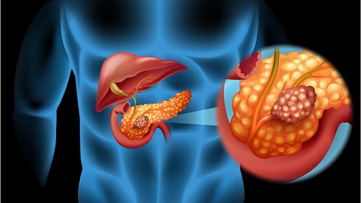 5 cosas que debe saber sobre el cáncer de páncreas
