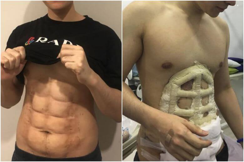 ¿Cual Gimnasio? Cirugía permanente de músculos abdominales la nueva tendencia en hombres (+fotos)